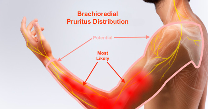 Brachioradial Pruritus: The Neuropathic Itch